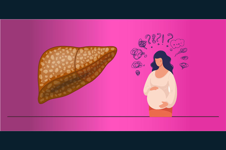 کبد چرب در بارداری چگونه است؟
